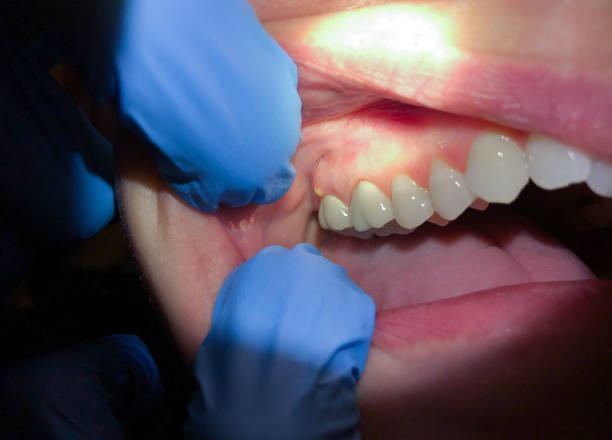 Best Chipped Tooth Repair Near Me  in Broadview Heights, OH